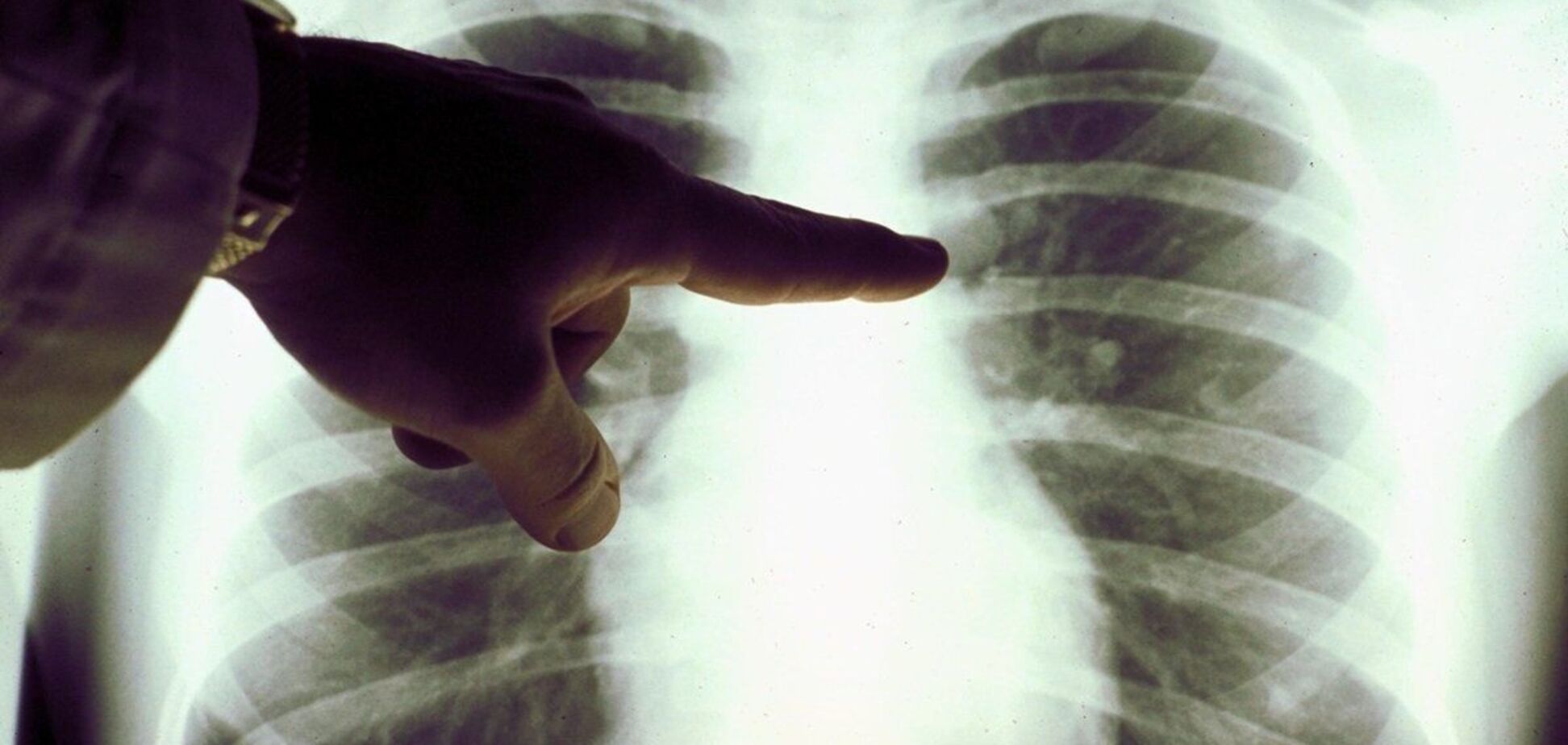 Лікар пояснив небезпеку вживання антибіотиків та противірусних у разі COVID-19