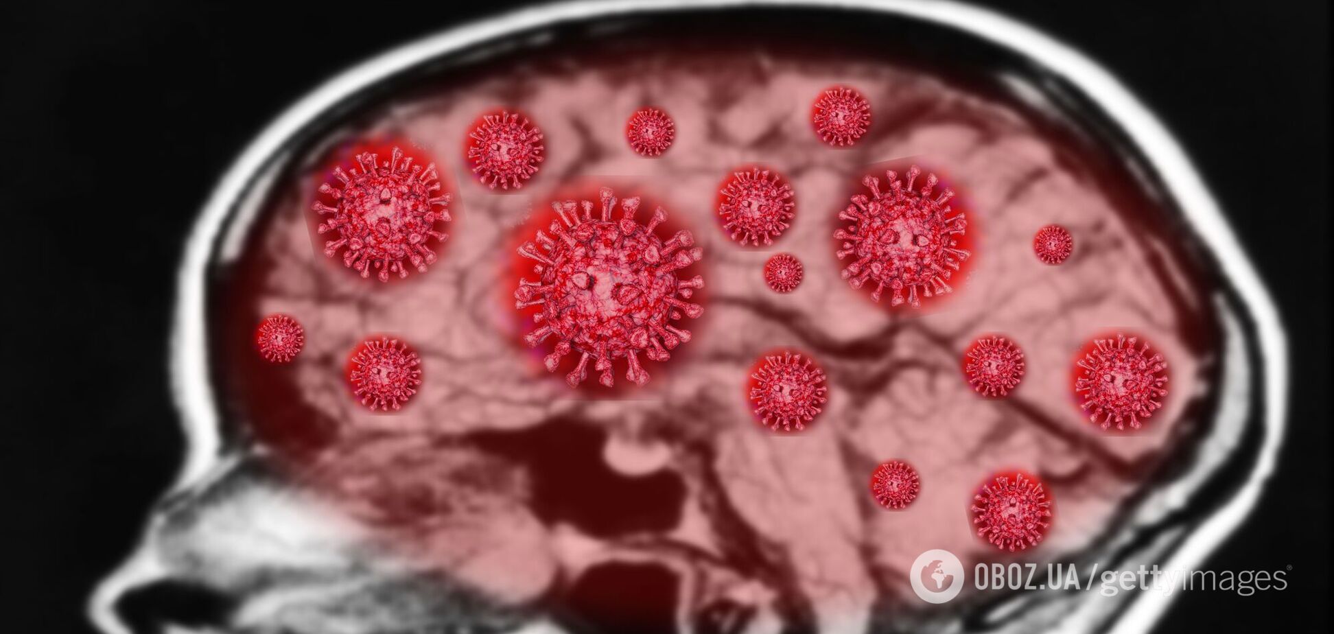 Коронавирус может попасть в мозг человека через нос