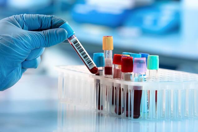 Перебіг COVID-19 можна передбачити за загальним аналізом крові – дослідження