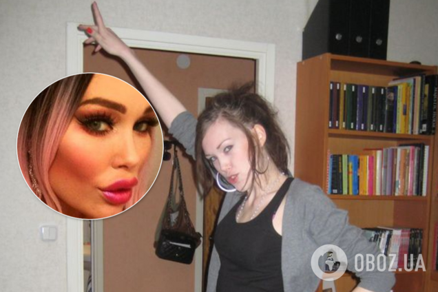 Шведка с лицом как в Snapchat показала себя после пластики