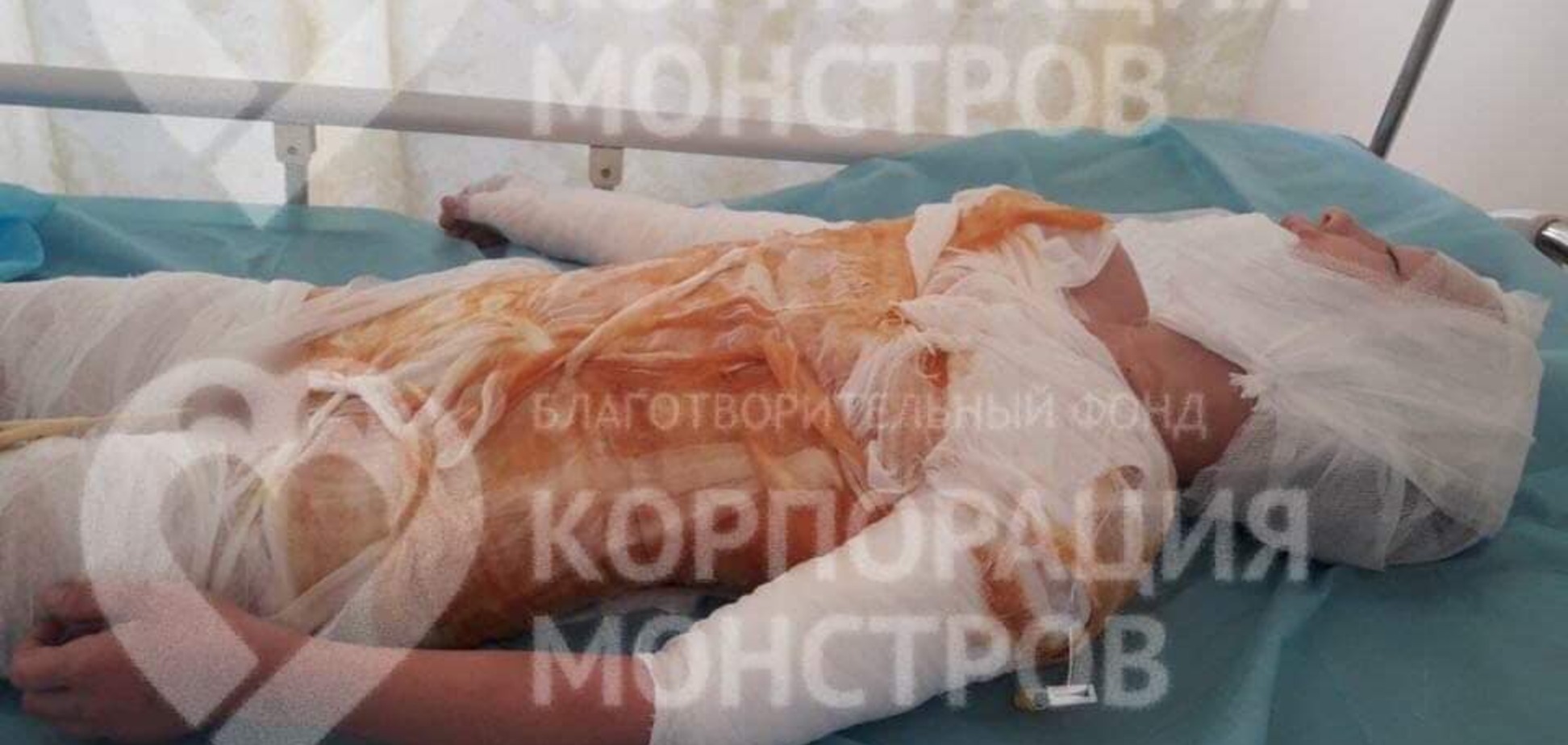 На Одесщине ребенок попал в больницу с жуткими ожогами