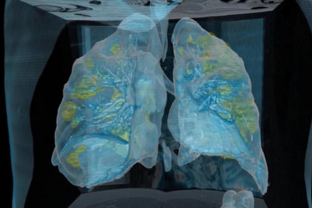 Що коронавірус робить із легенями людини: лікарі показали моторошне відео