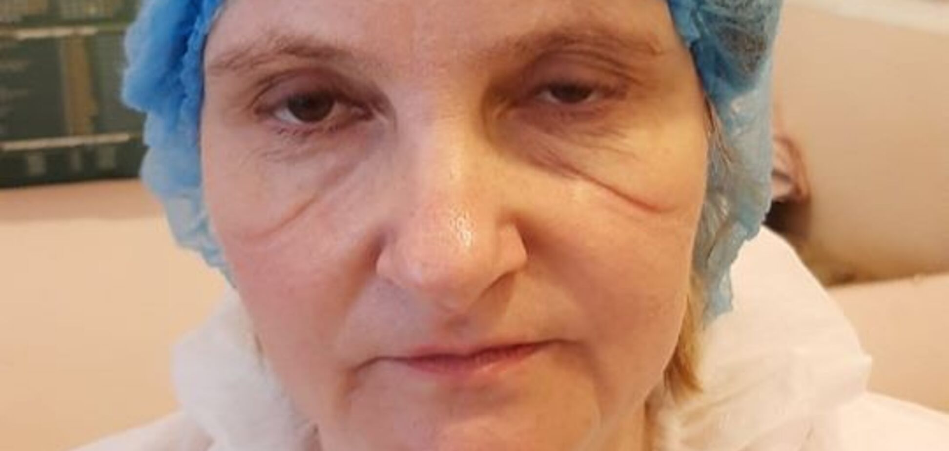 Фото киевской медсестры со шрамами от маски растрогало украинцев