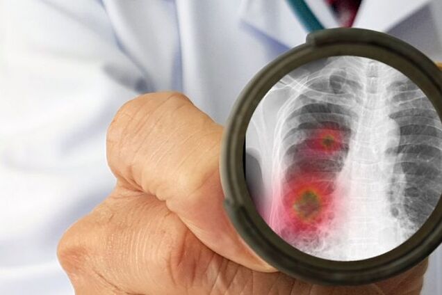 От пневмонии умерла жительница Одесщины, которую несколько часов везли в больницу