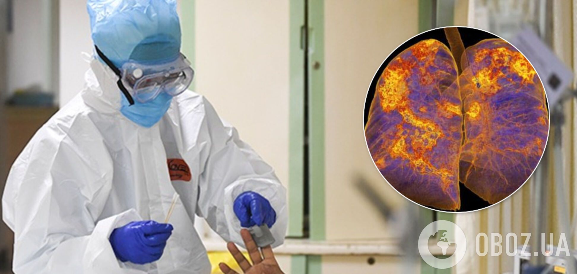 Лікарка розповіла про страшне ураження легень у померлої від COVID-19 українки
