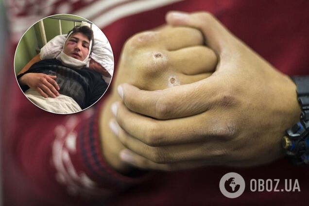 Сломаны нос и челюсть: на Донетчине экс-полицейский жестоко избил подростка. Видео