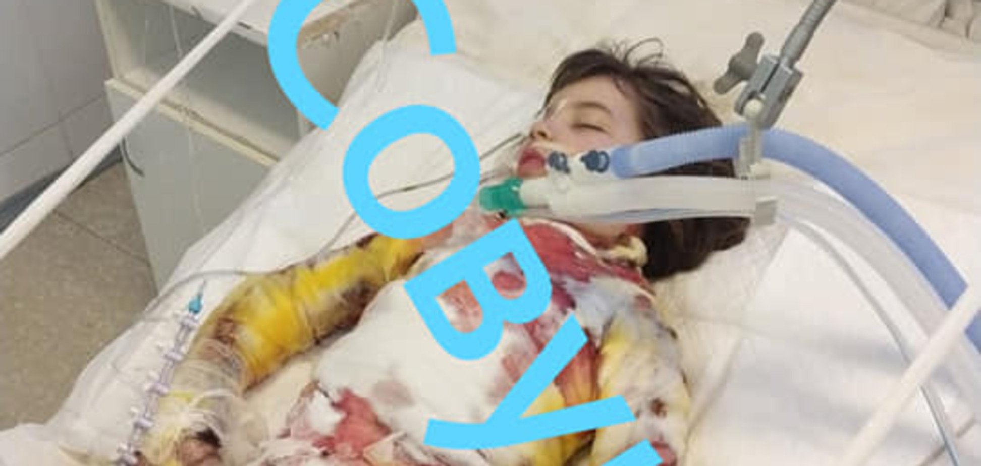 Под Днепром на пожаре пострадал ребенок: девочку забрали в реанимацию