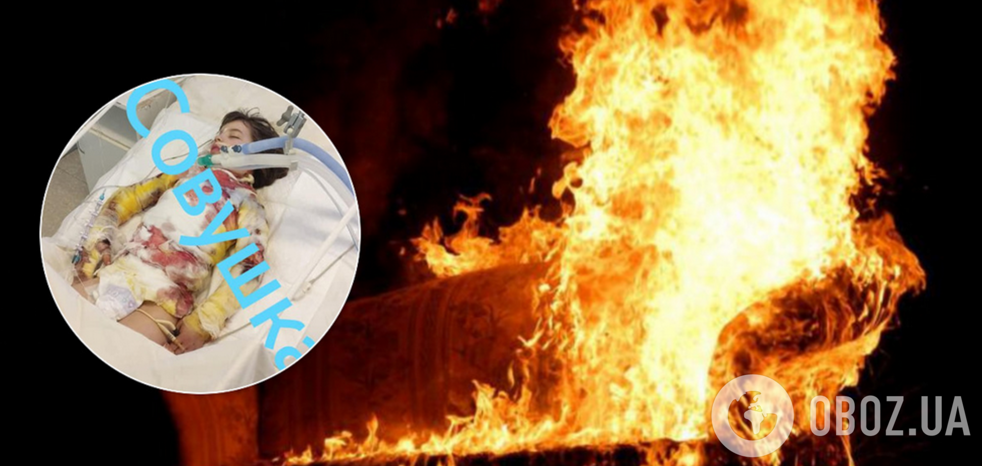 Стало известно о состоянии девочки, пострадавшей при пожаре на Днепропетровщине