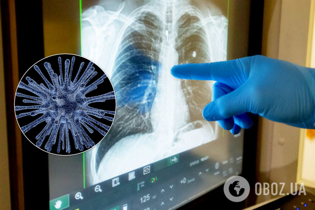 Безсимптомний коронавірус вражає легені: вчені зробили тривожне відкриття
