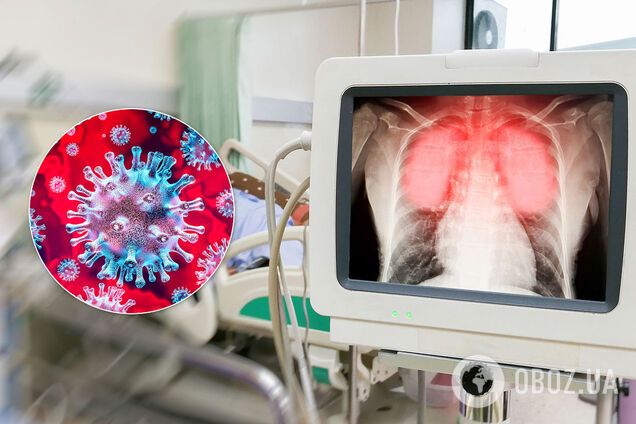 Эффект 'матового стекла' у бессимптомных больных COVID-19: что это такое