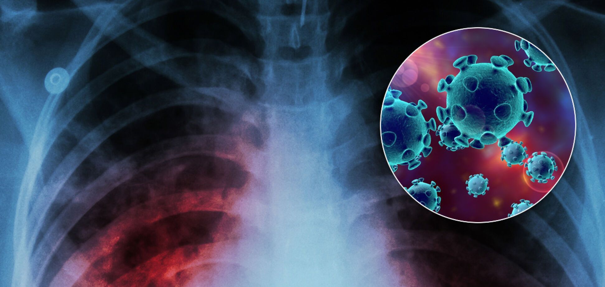 Могут погибнуть 1,4 миллиона: после пандемии COVID-19 миру грозит новая опасность
