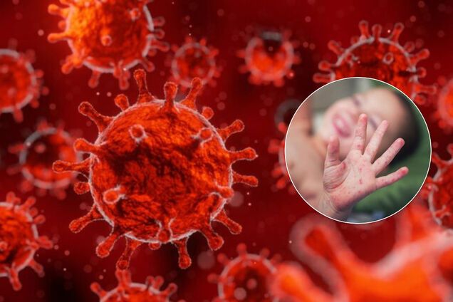 Возможно, из-за COVID-19: в США и Италии зафиксировали 30-кратный рост болезни, поражающей сосуды