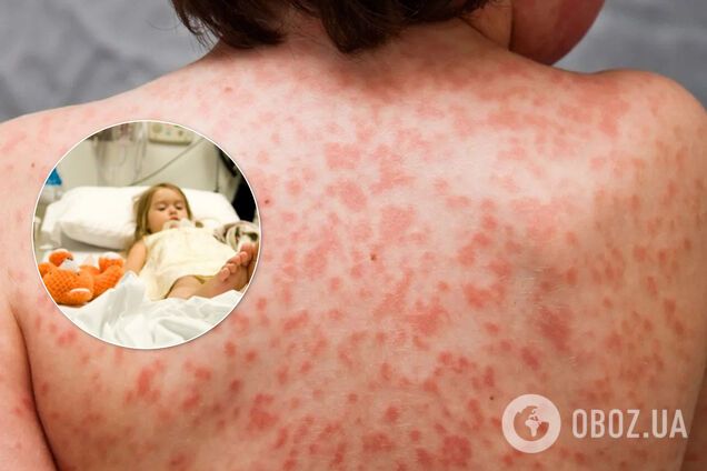 Новая болезнь поражает детей
