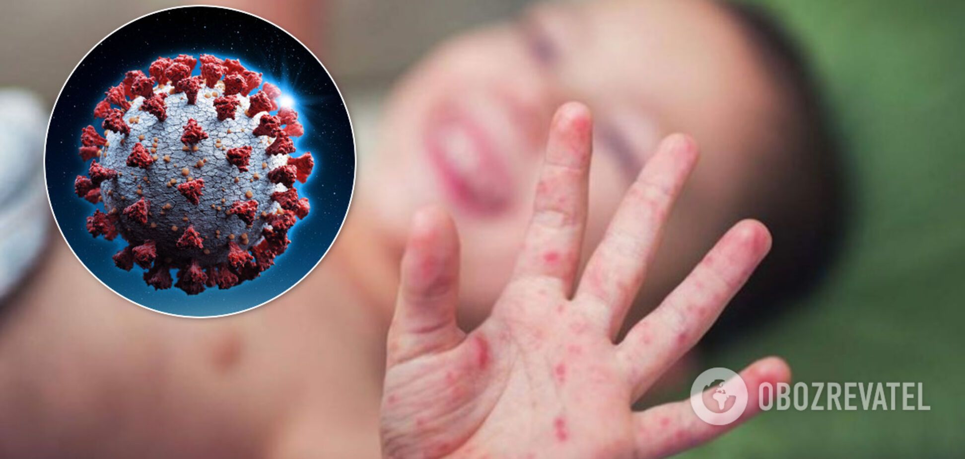 В Україні дітей вразив небезпечний синдром, пов'язаний із COVID-19. Він призводить до токсичного шоку та інсульту