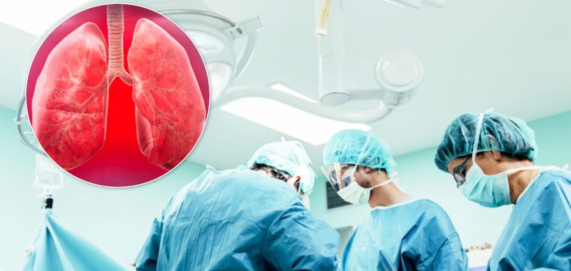В Австрії вперше пересадили легені жінці, яка хворіла на COVID-19