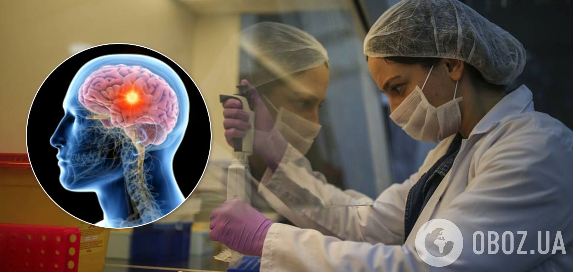 Знайдено препарат проти смертельної пухлини мозку: підвищує виживання