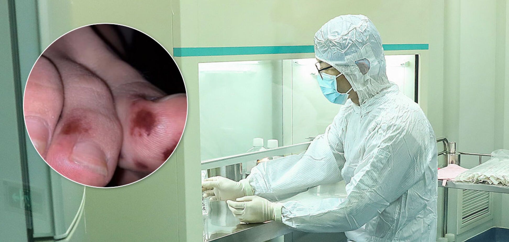 Єдиний симптом – на ногах: лікарі розповіли про масу загадкових звернень хворих COVID-19