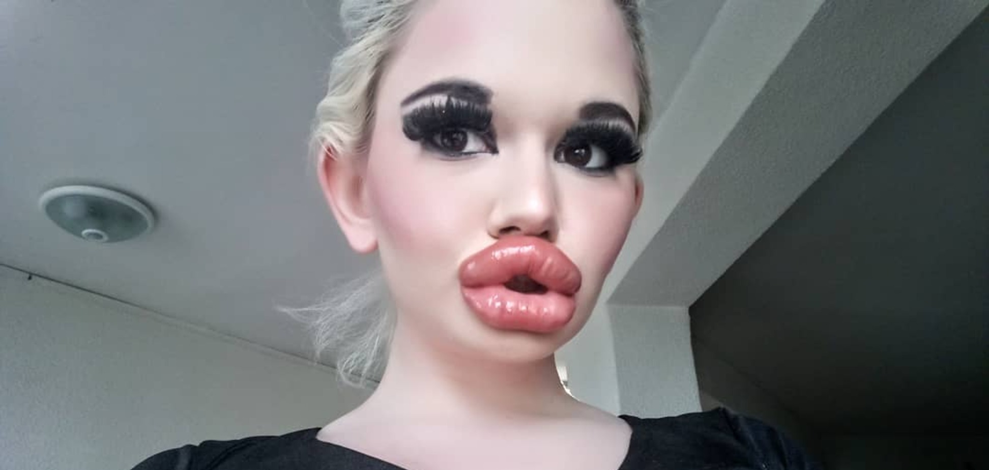 Дівчина зробила собі найбільші губи в світі: як виглядає