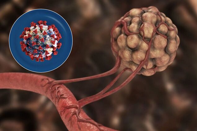 Пандемія вдарила по онкохворих: у Британії рак могли не виявити у тисяч людей