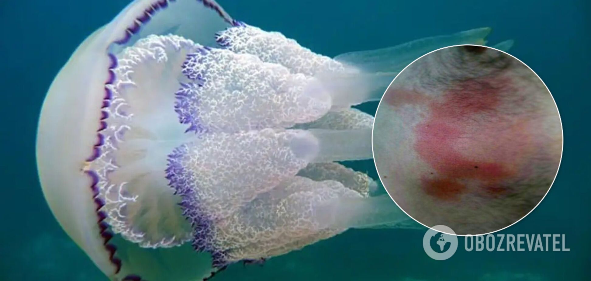 У відпочивальників у Бердянську опіки від медуз