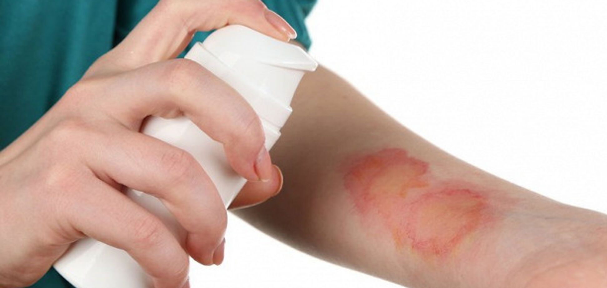 Проблемы с кожей летом: врач из Днепра рассказала о первой помощи и опасностях