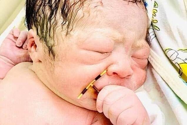 Немовля народилося з контрацептивом (фото: Hai Phond International Hospital)
