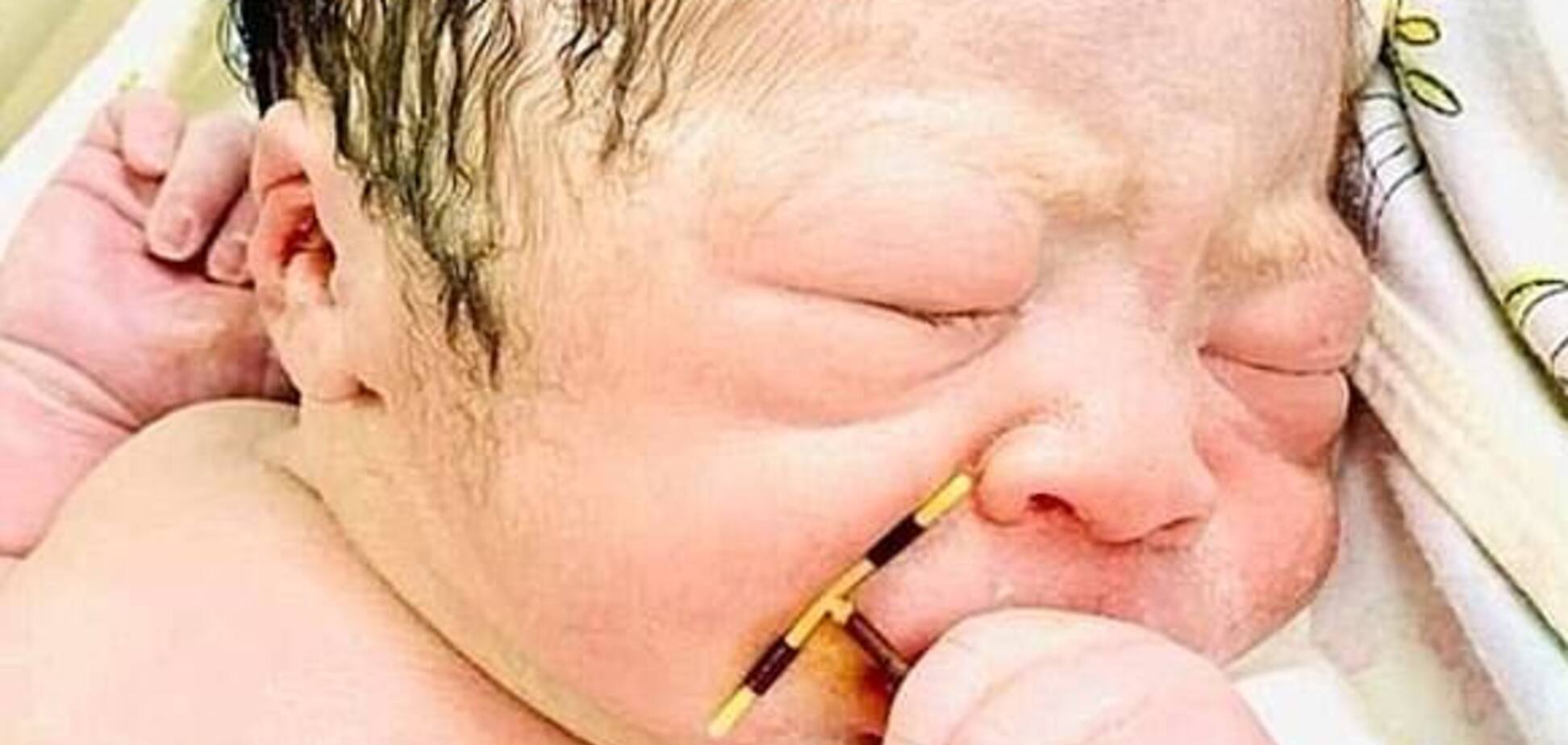 Младенец родился с контрацептивом (фото: Hai Phond International Hospital)