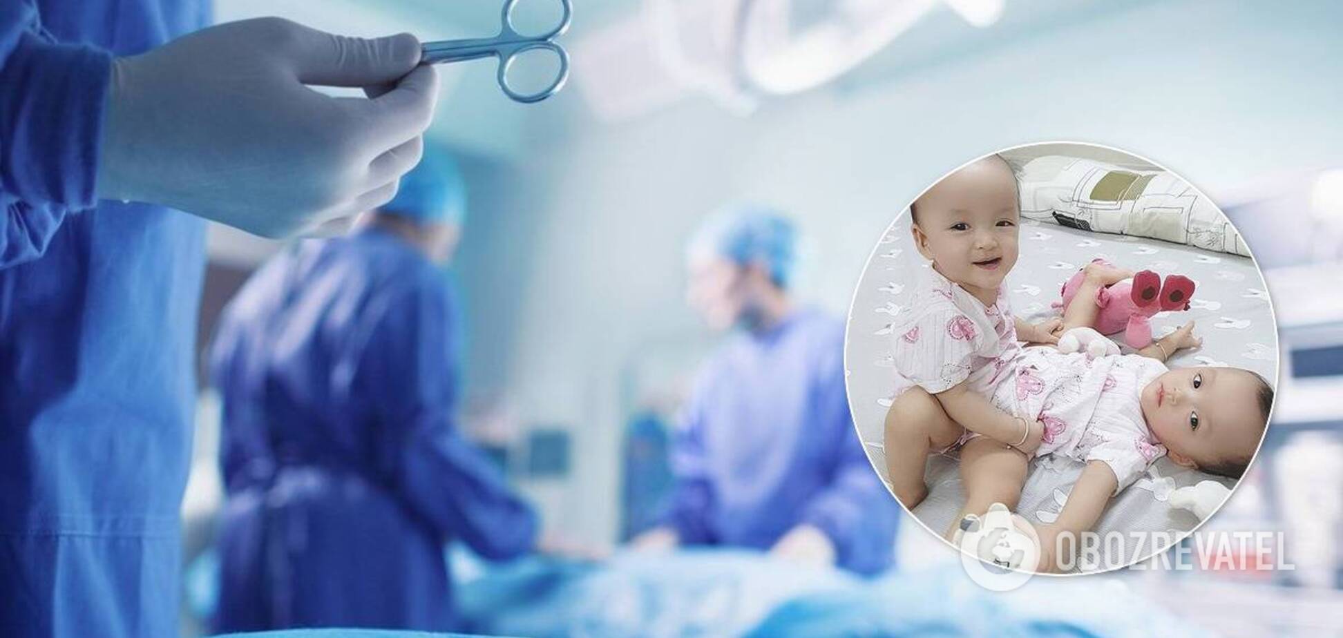 Во Вьетнаме разделили сросшихся близняшек