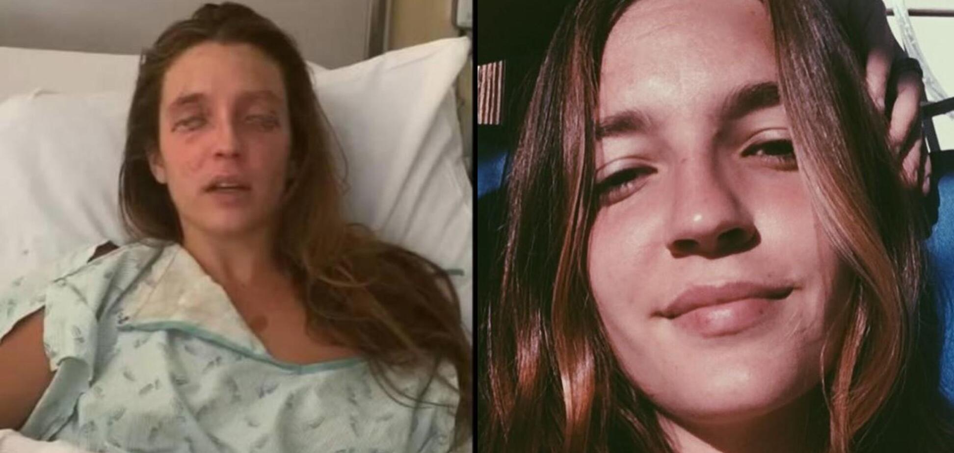 Девушка сожгла глаза после применения домашней косметики. Фото до и после