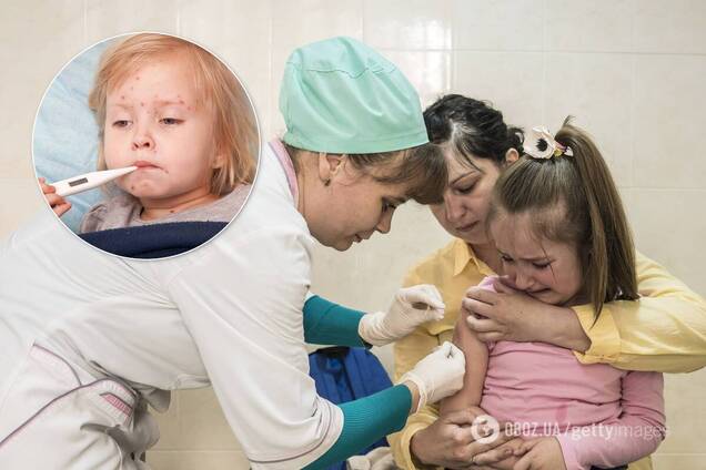 В Украине может вновь вспыхнуть эпидемия кори: медики забили тревогу