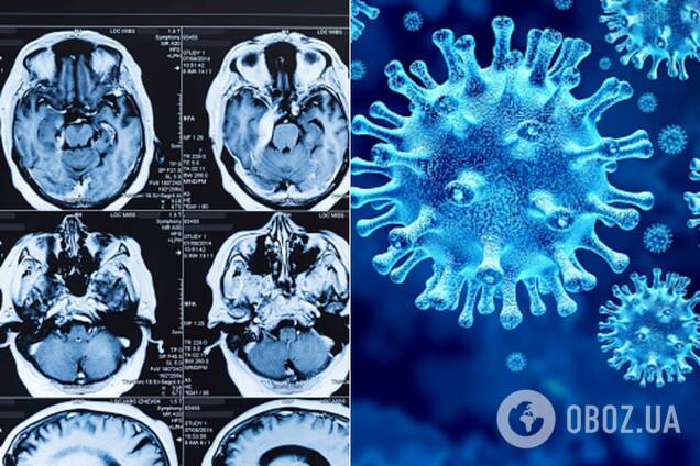 Коронавирус может привести к повреждению мозга