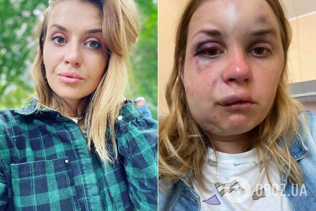 Анастасія Лугова до і після нападу