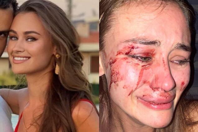 В Турции избили известную украинскую топ-модель: детали ЧП и фото 18+