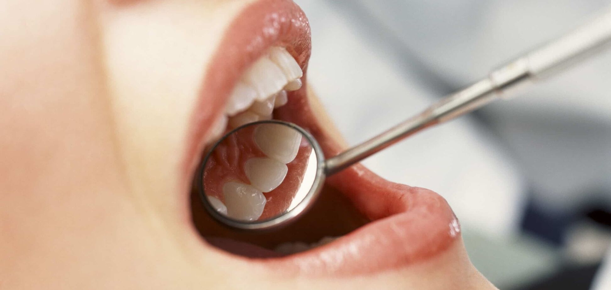 Удаление зуба в Киеве: клиника стоматологии Ideale приглашает на безболезненное лечение