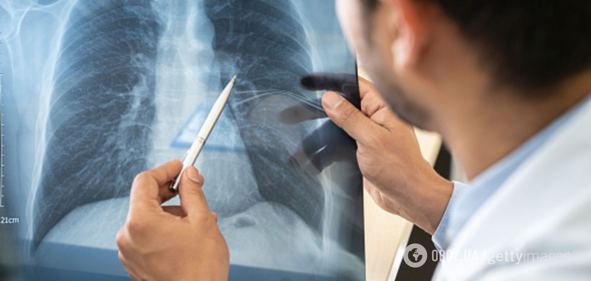 Лікарі пересадили легені пацієнту, який постраждав від коронавірусу