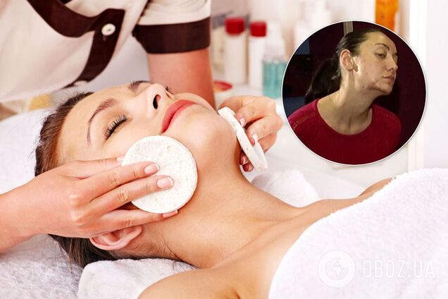 Українка розповіла, як через візит до косметолога втратила красу, кар'єру і майно