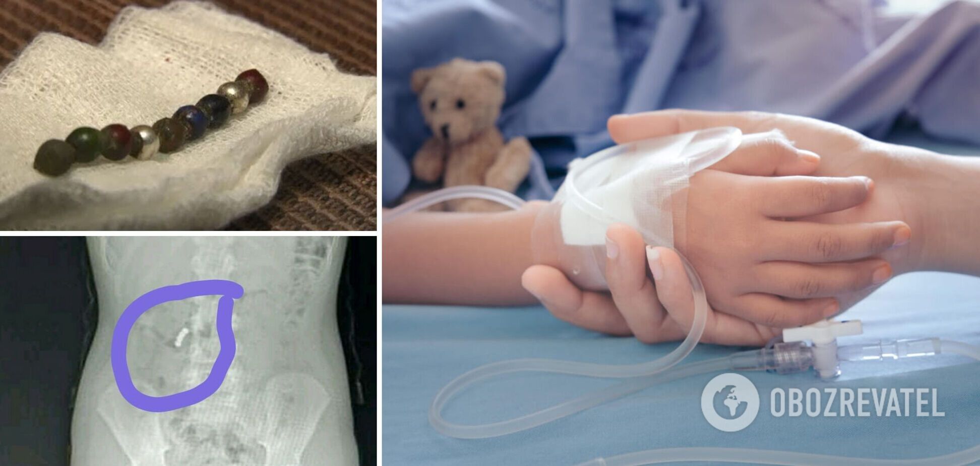 На Одесщине школьница проглотила магниты, ей потребовалась срочная помощь. Фото