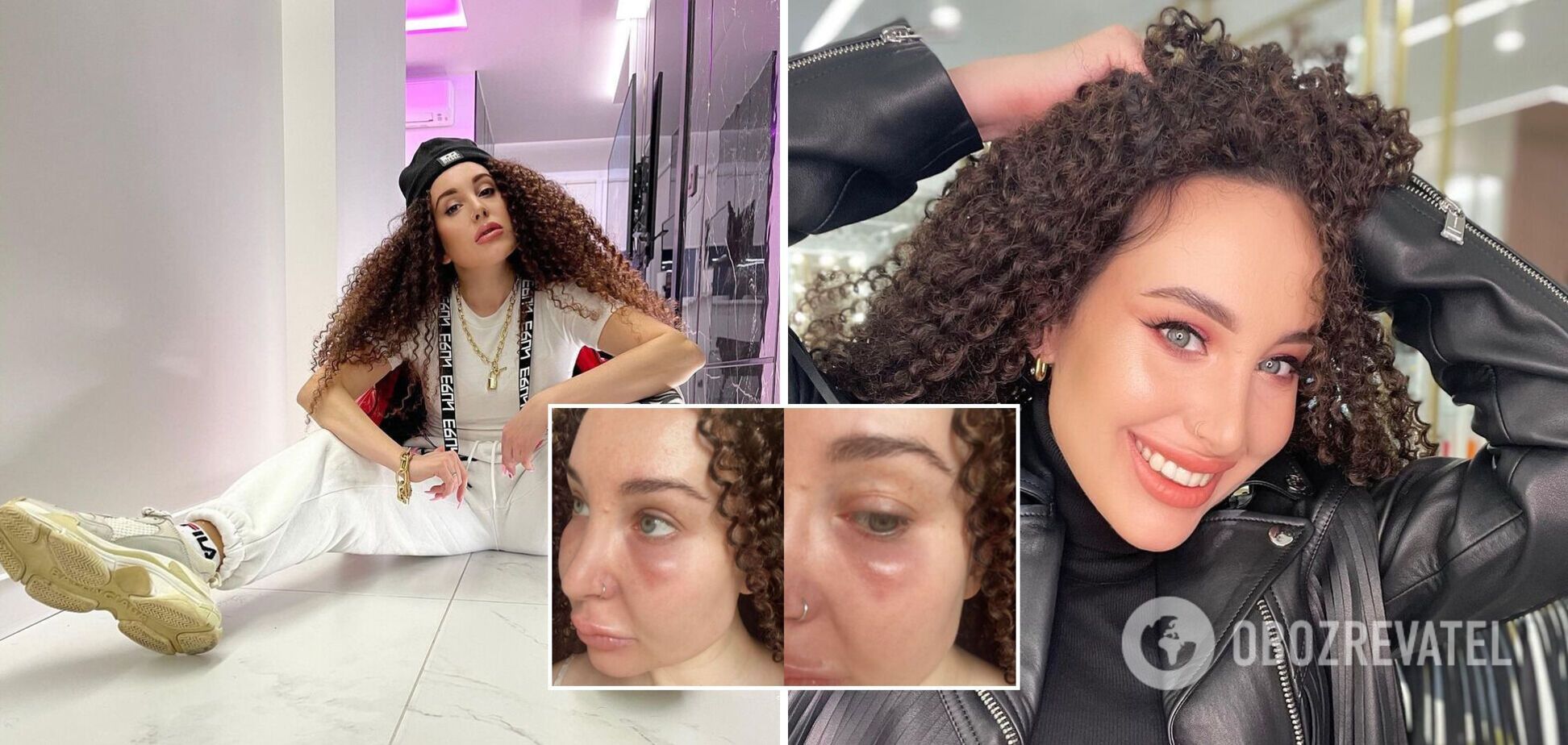 'Пітнію, кричу на всіх, плачу': співачка SHADU налякала мережу знівеченим обличчям після косметолога. Фото