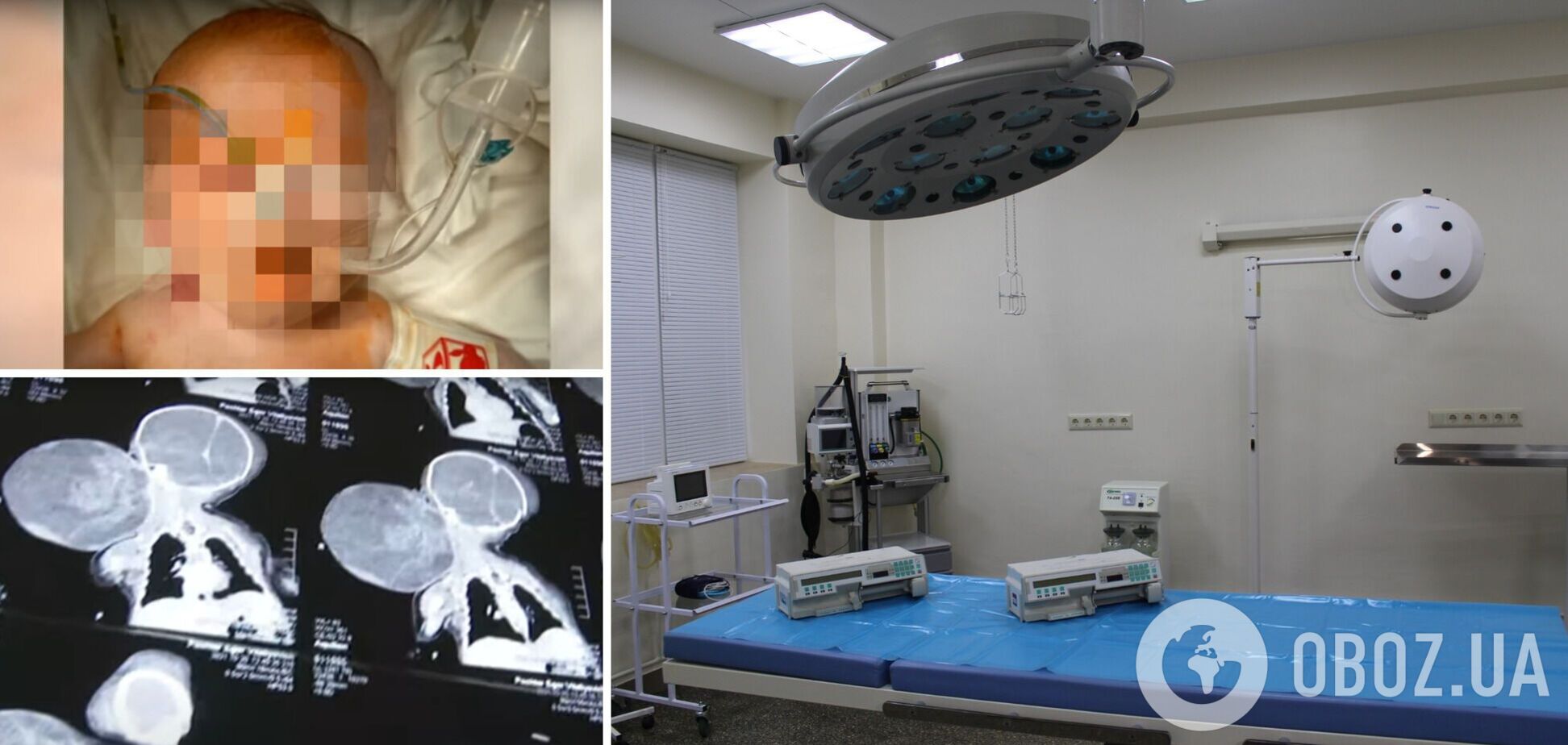 В Україні вперше прооперували новонародженого із пухлиною, більшою за голову. Відео