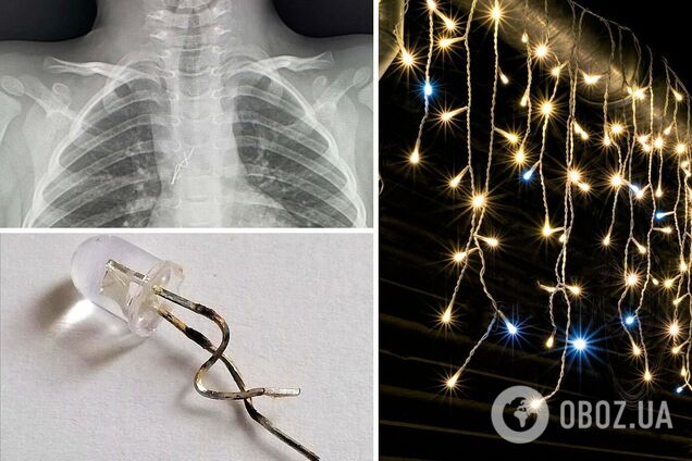 Львовские медики достали из трахеи 4-летнего ребенка лампочку от гирлянды. Фото