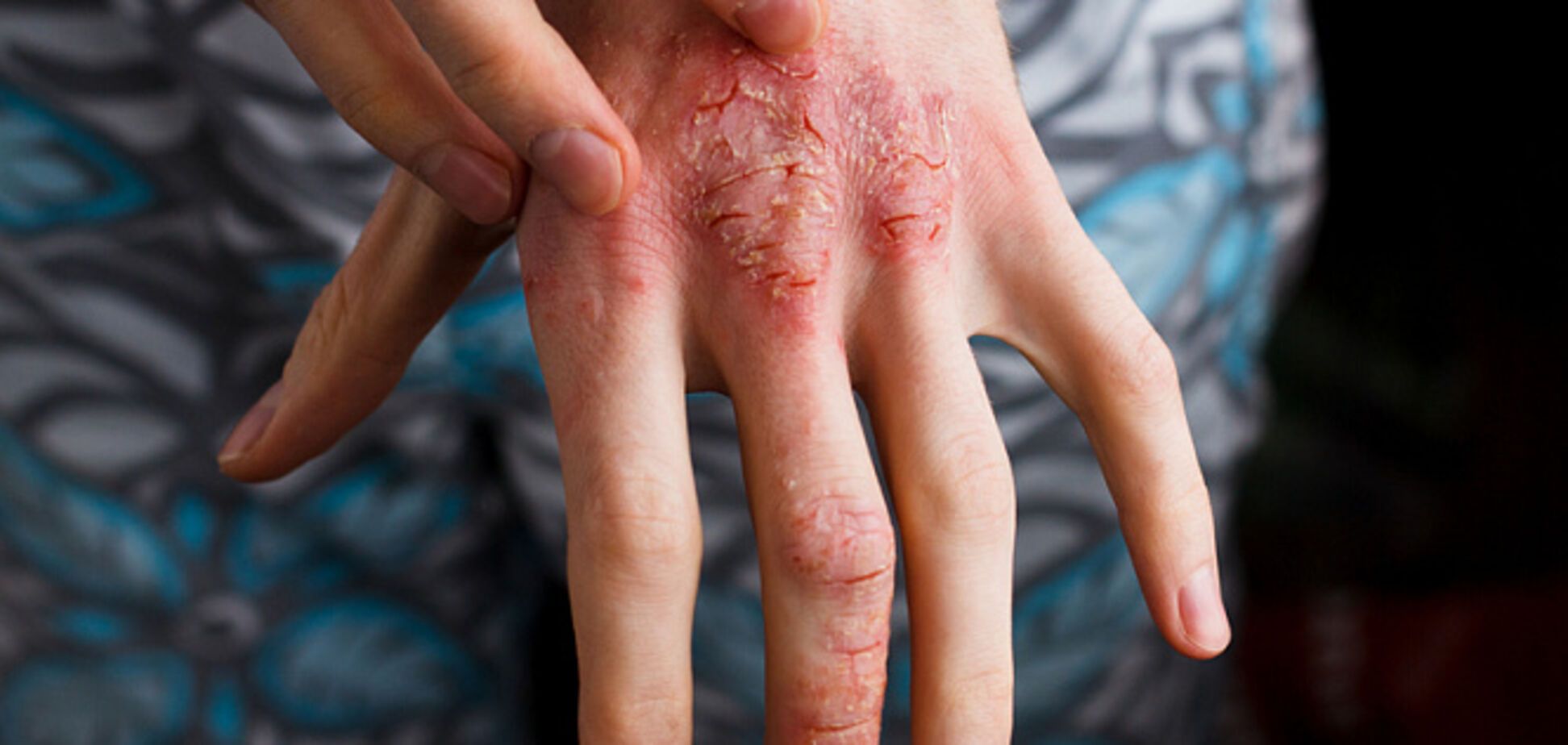 Лечение атопического дерматита: новые данные ученых