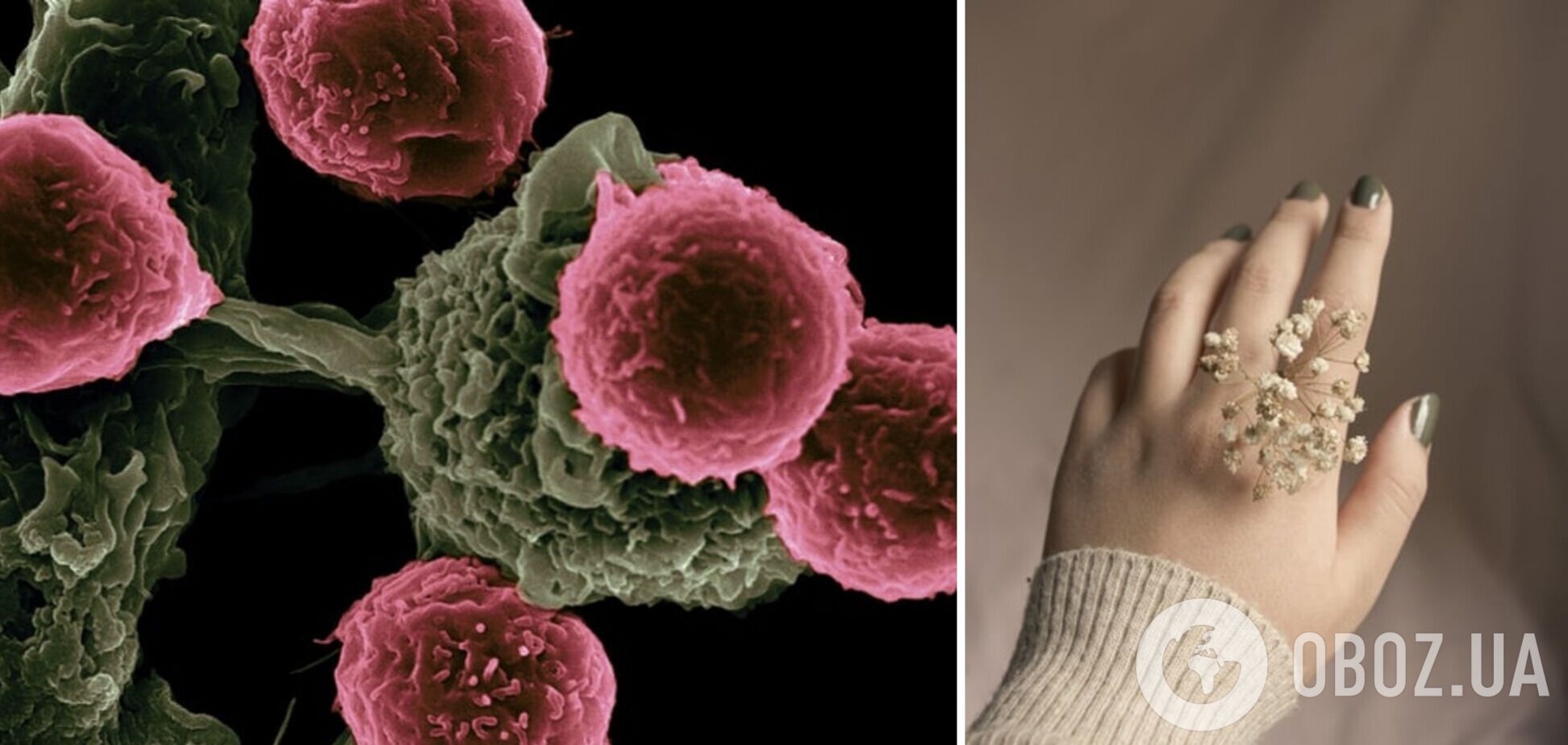 Вчені назвали ознаку раку, яка може проявлятися на нігтях
