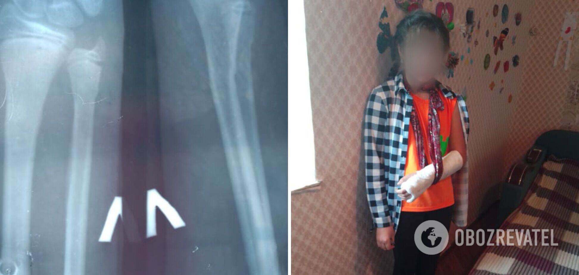 11-летняя Лиза на уроке физкультуры сломала руку в двух местах
