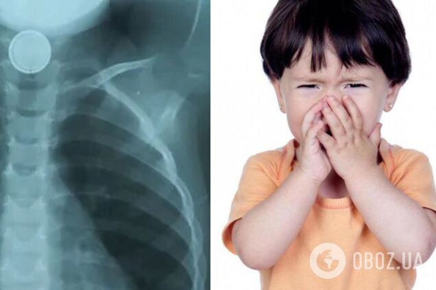 Врачи удалили посторонний предмет