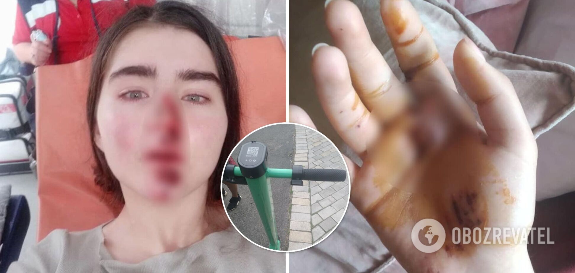 В Киеве девушка разбила лицо из-за неисправного самоката: за это ей предложили 200 гривен. Фото