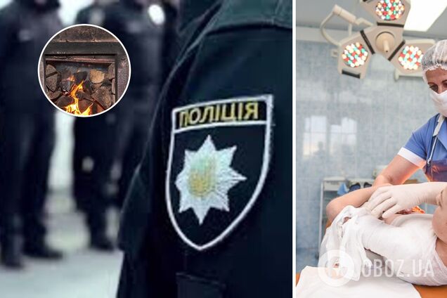 В Одесской области трое детей получили ожоги лица и рук из-за халатности отца