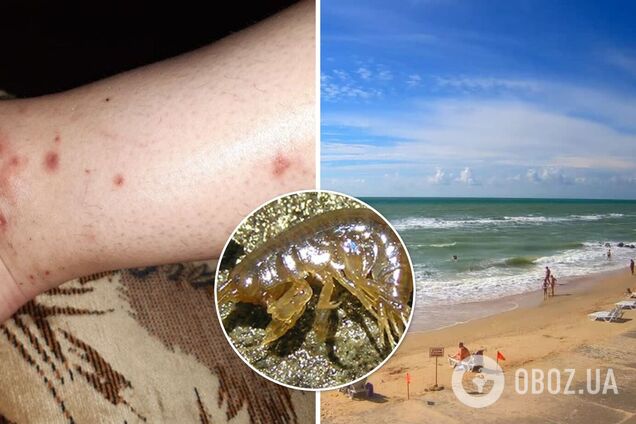 Морські блохи знову атакували туристів на Азовському морі: чим небезпечні і що потрібно знати