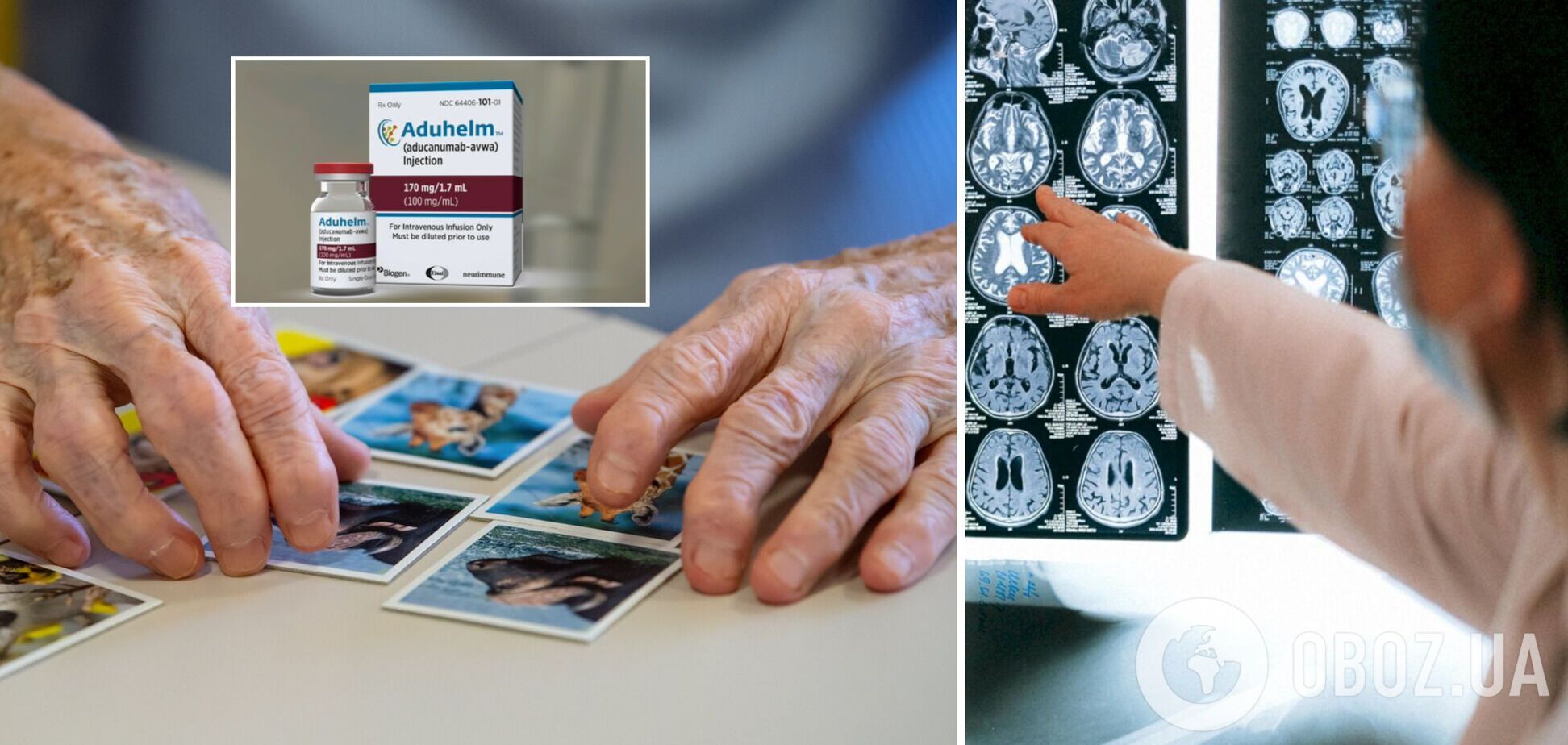 Новые лекарства от болезни Альцгеймера одобрили впервые за 20 лет