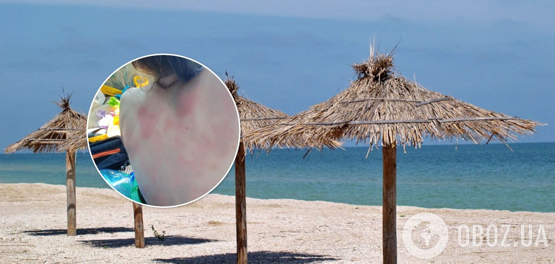 Тело девочки покрылось красными пятнами после купания в море в Кирилловке. Фото