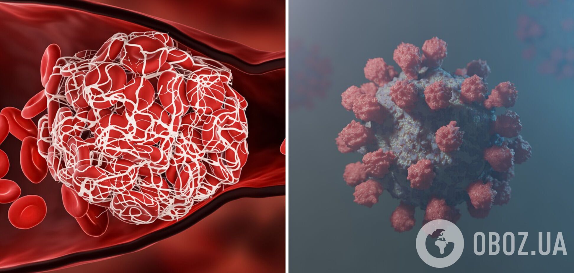 Тромбоз виникає при тяжкому перебігу коронавірусу